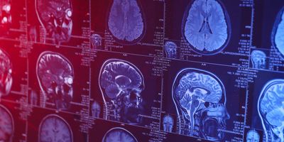 Photo of an MRI of the human head and brain.