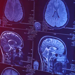 Photo of an MRI of the human head and brain.