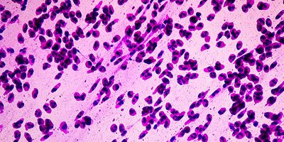 Photo of cancer cell histology micrograph.