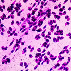 Photo of cancer cell histology micrograph.