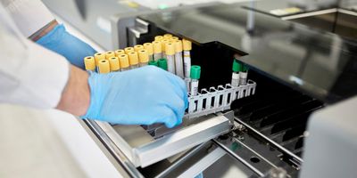 A clinical laboratory professional wearing a white lab coat and blue gloves loads CSF brain cancer samples for analysis.