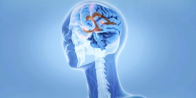 Illustration of the human brain showing normal pressure hydrocephalus.