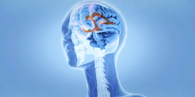 Illustration of the human brain showing normal pressure hydrocephalus.
