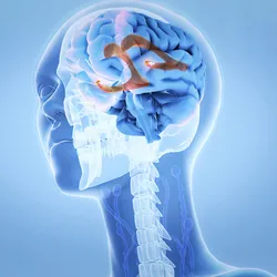 Illustration of the human brain showing normal pressure hydrocephalus.