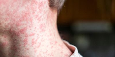 Photo of a person's neck where the skin is covered with measles rash.