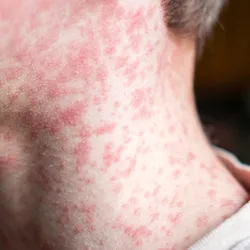 Photo of a person's neck where the skin is covered with measles rash.
