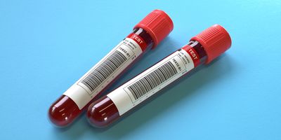 Fujirebio Receives 510(k) Clearance for Lumipulse® G pTau 217/ β-Amyloid 1–42 Plasma Ratio IVD Test for Alzheimer’s Disease