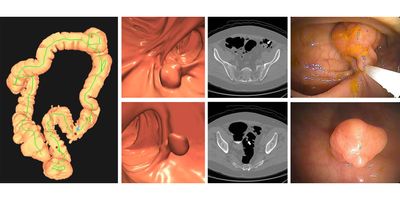 Images of positive CT colonography (CTC) screening examination result in an asymptomatic 67-year-old man. Three-dimensional colon map from CTC (left image) shows the location of two sigmoid polyps that were detected (red dots). Three-dimensional endoluminal and confirmatory two-dimensional transverse CTC images show a large 1.6-cm pedunculated polyp on top row (arrow) and a 9-mm pedunculated polyp in the distal sigmoid on the bottom row (arrow). Both polyps were confirmed and resected at optical colonoscopy performed the same day (right images), avoiding the need for a second bowel preparation. The larger polyp proved to be a tubulovillous adenoma (large advanced adenoma), whereas the smaller polyp was a nonadvanced tubular adenoma. Compare this level of information of a positive CTC screening test result with a positive multitarget stool DNA test result, for which no specific information is provided.