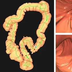 Images of positive CT colonography (CTC) screening examination result in an asymptomatic 67-year-old man. Three-dimensional colon map from CTC (left image) shows the location of two sigmoid polyps that were detected (red dots). Three-dimensional endoluminal and confirmatory two-dimensional transverse CTC images show a large 1.6-cm pedunculated polyp on top row (arrow) and a 9-mm pedunculated polyp in the distal sigmoid on the bottom row (arrow). Both polyps were confirmed and resected at optical colonoscopy performed the same day (right images), avoiding the need for a second bowel preparation. The larger polyp proved to be a tubulovillous adenoma (large advanced adenoma), whereas the smaller polyp was a nonadvanced tubular adenoma. Compare this level of information of a positive CTC screening test result with a positive multitarget stool DNA test result, for which no specific information is provided.