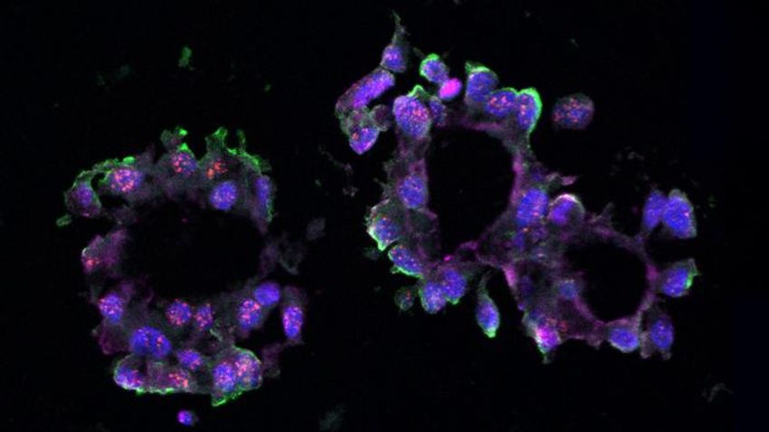 This triple-negative breast cancer organoid was grown in the lab using tissue samples donated by a volunteer patient. LINC01235 is seen in red. This triple-negative breast cancer organoid was grown in the lab using tissue samples donated by a volunteer patient. LINC01235 is seen in red.