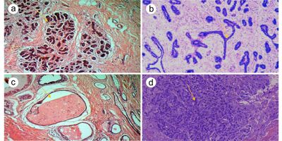 Researchers identified key spectral biomarkers, related to protein content and cell structure, that clearly distinguished between normal, benign, and malignant tissues.
