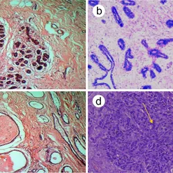 Researchers identified key spectral biomarkers, related to protein content and cell structure, that clearly distinguished between normal, benign, and malignant tissues.