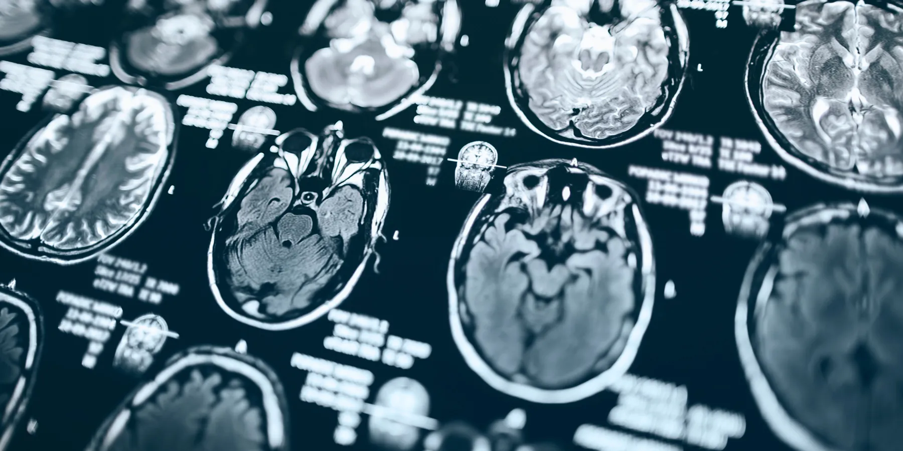 Vaccination remains the best prevention against life-threatening complications like influenza-associated acute necrotizing encephalopathy.