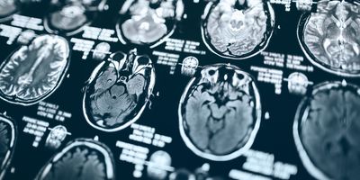 Vaccination remains the best prevention against life-threatening complications like influenza-associated acute necrotizing encephalopathy.