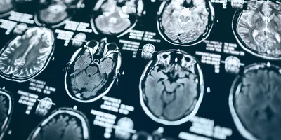 Vaccination remains the best prevention against life-threatening complications like influenza-associated acute necrotizing encephalopathy.