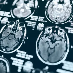 Vaccination remains the best prevention against life-threatening complications like influenza-associated acute necrotizing encephalopathy.