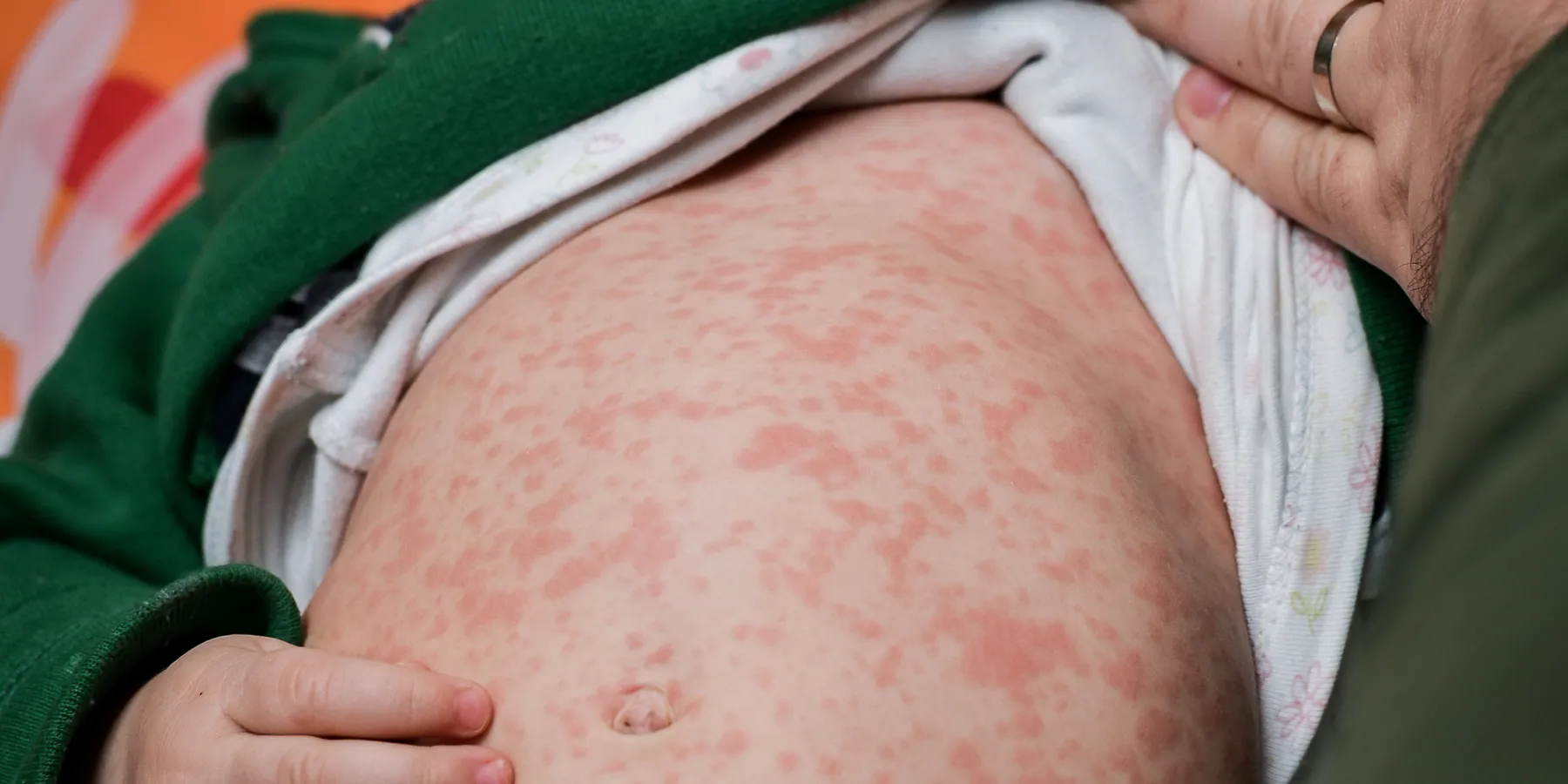 new-model-predicts-measles-vaccination-coverage-using-routine-clinical-data A collaborative team from Penn State and the World Health Organization (WHO) has created a novel method to predict measles vaccination levels using routinely collected clinical data from suspected measles cases.