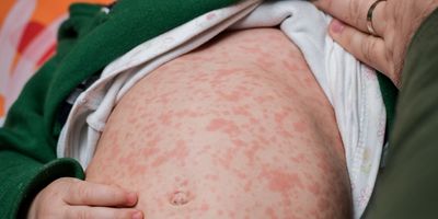 A collaborative team from Penn State and the World Health Organization (WHO) has created a novel method to predict measles vaccination levels using routinely collected clinical data from suspected measles cases.