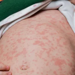 A collaborative team from Penn State and the World Health Organization (WHO) has created a novel method to predict measles vaccination levels using routinely collected clinical data from suspected measles cases.
