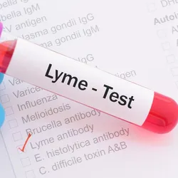 Lyme disease, a tick-transmitted infection that is principally caused by the spirochete Borrelia burgdorferi in the United States and closely related species in Europe, has become the most common vector-borne disease in the US.