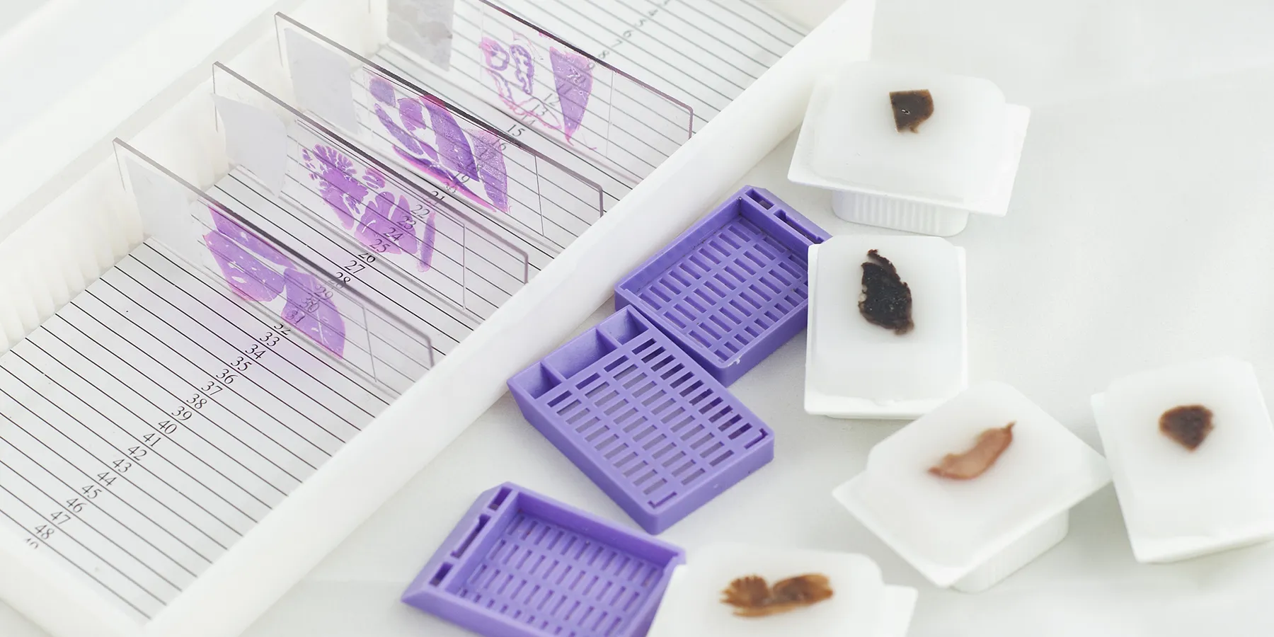 Researchers performed whole-exome sequencing of 21 uterine cancers that were associated with previous tamoxifen use, and compared their genetic makeup with those of non-tamoxifen-associated uterine cancers in published databases.