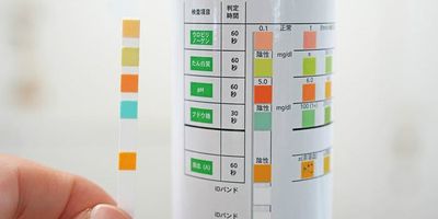 Kobe University ISHIMORI Shingo and his team found that the most common reason why patients were referred to hospital for testing for Alport syndrome was due to age-3 urine screening results. In addition, 60% of these people already met the conditions for treatment.