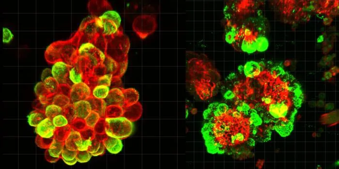 Cancer cells (red) stick to mesothelial cells (green) and form hybrid spheres that cut into surrounding abdominal tissue.