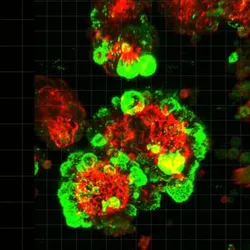 Cancer cells (red) stick to mesothelial cells (green) and form hybrid spheres that cut into surrounding abdominal tissue.