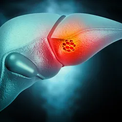 Most cell-free DNA tests aim to detect tumors by sniffing out changes in cell-free DNA that accompany malignant transformation. 
