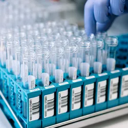 The study shows that the concentration of DOPA decarboxylase in cerebrospinal fluid is significantly higher in patients with Parkinson's disease or Lewy body dementia.