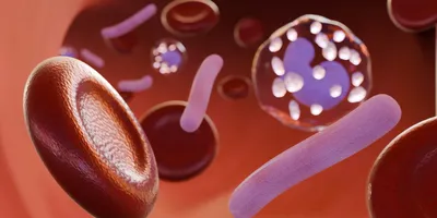 Sepsis is a serious complication arising from infection, which can swiftly progress to life-threatening organ failure.