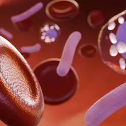 Sepsis is a serious complication arising from infection, which can swiftly progress to life-threatening organ failure.
