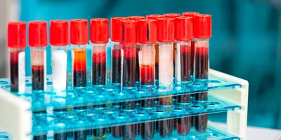 Blood samples in vials for testicular cancer diagnosis in the clinical laboratory.
