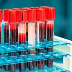 Blood samples in vials for testicular cancer diagnosis in the clinical laboratory.