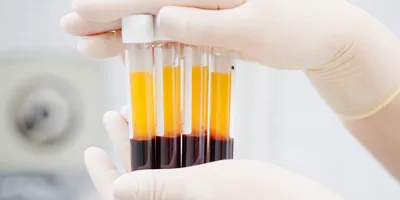 Blood samples in test tubes for glycated albumin testing in the clinical lab.