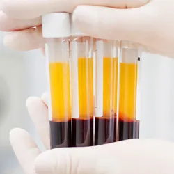 Blood samples in test tubes for glycated albumin testing in the clinical lab.