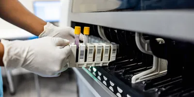 Laboratory technician preparing samples for pediatric testing in a clinical laboratory.
