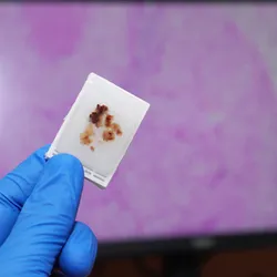 Clinical lab scientist holding a sample for PTEN protein assessment in prostate cancer.